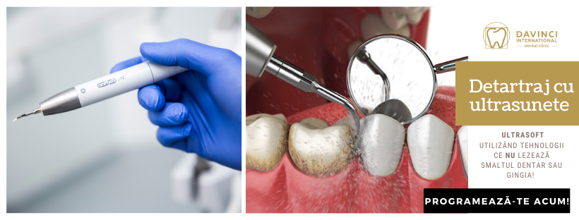 detartrajul cu ultrasunete davinci dental clinic